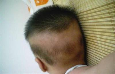 宝宝头发稀少是什么原因
