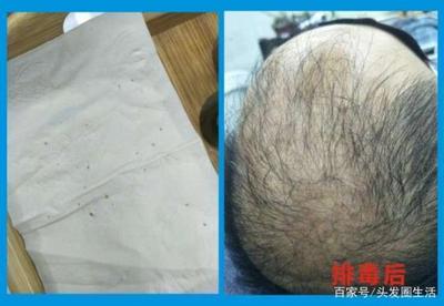 头皮长痘痘痛