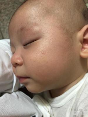 怎样能治好痘痘