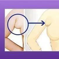 怀孕长副乳怎么办
