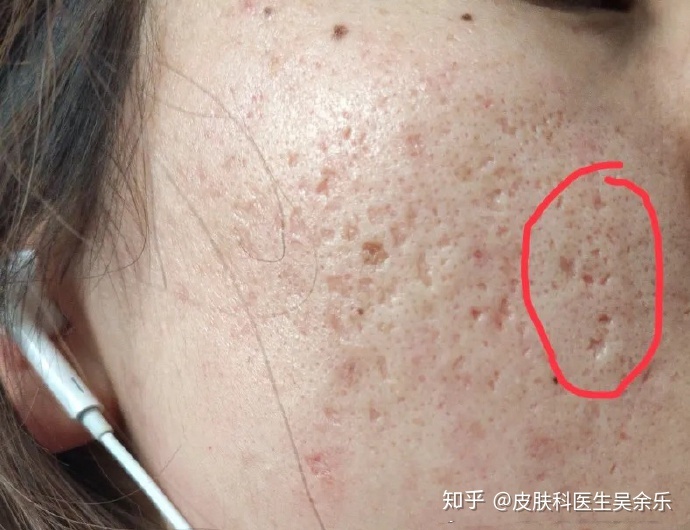 痘坑怎么治疗