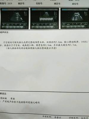 一般羊水多少正常