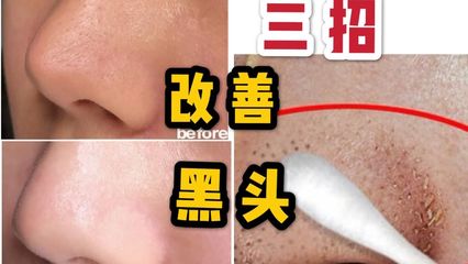 美容院清理超大黑头