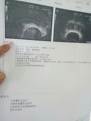 排卵期囊肿