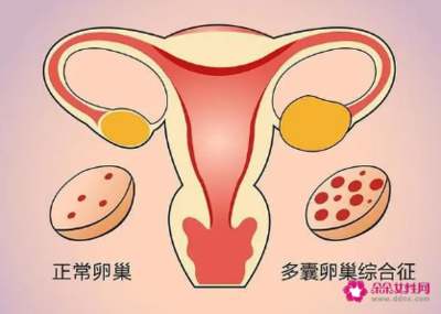 多囊会影响怀孕吗