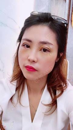 做了双眼皮发现怀孕了