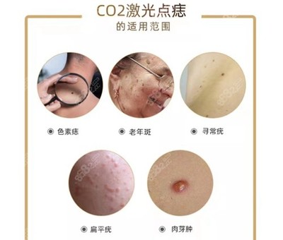 激光点痣 价格