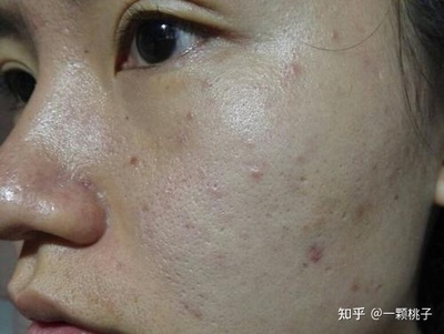 长痘痘毛孔粗大肤色不均