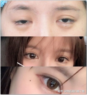 双眼皮修复失败