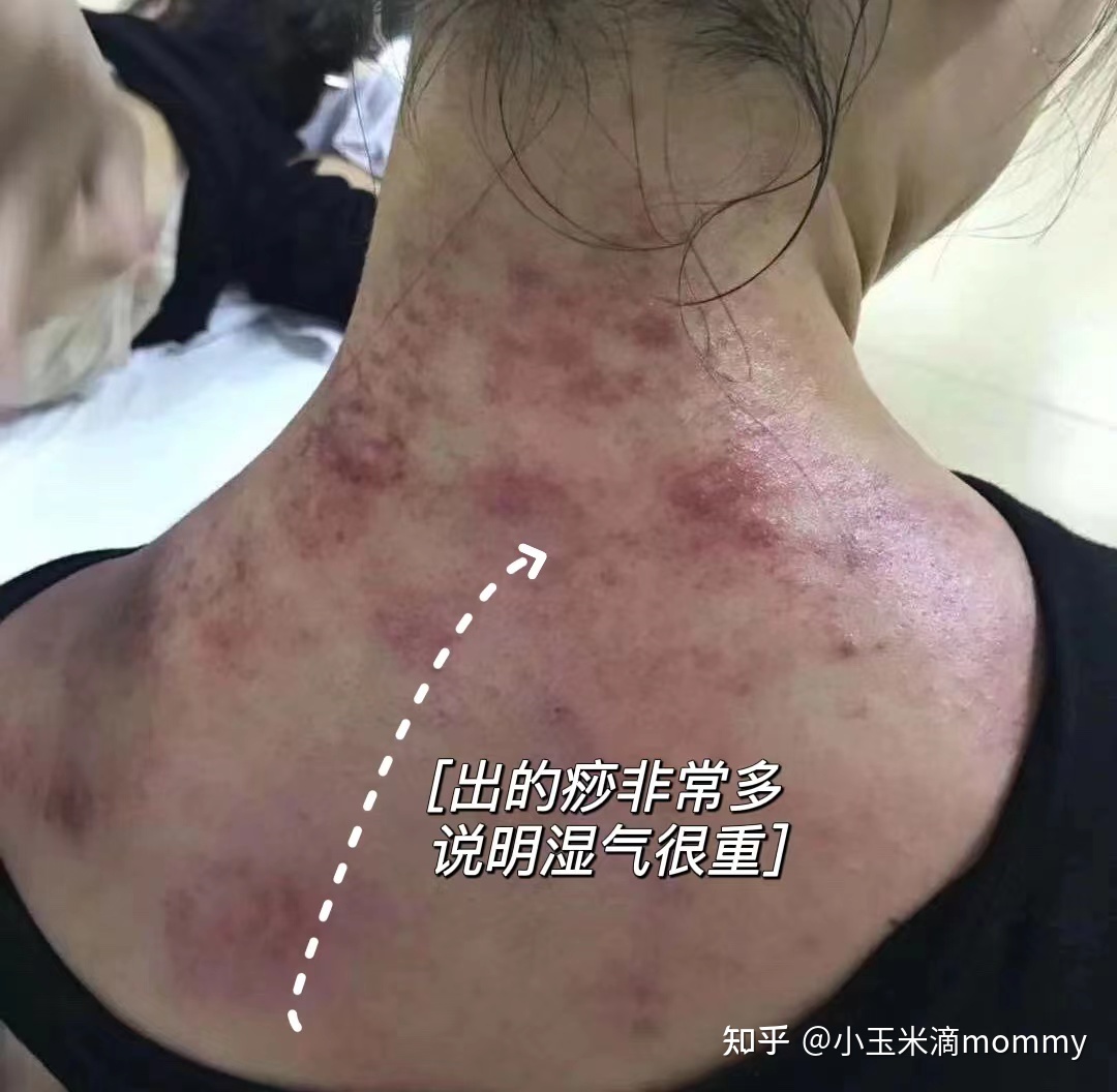 粉瘤和痘痘的区别