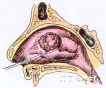 下鼻甲肥大怎么治疗