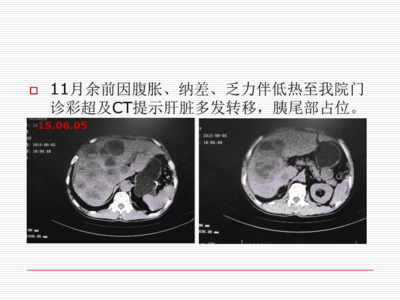 胃间质瘤是怎么回事