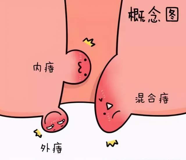 内痔外痔怎么治疗