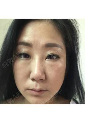 打了玻尿酸要肿多久