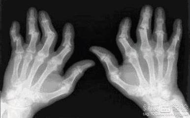 手指关节风湿怎么治疗