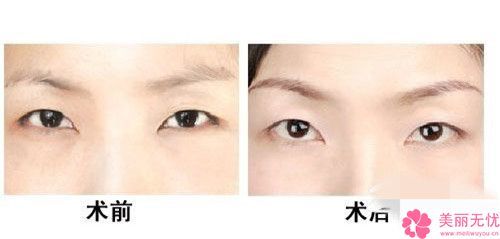 绣眉后几天可以沾水