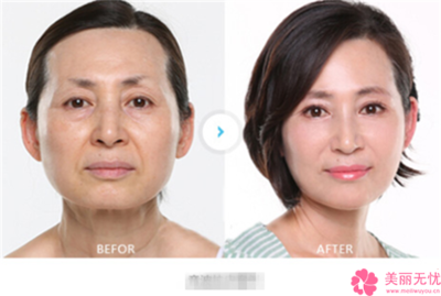 皮肤专家消除痘痘
