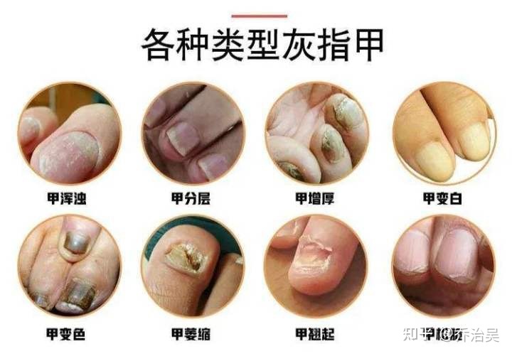 脚趾甲增厚是怎么回事