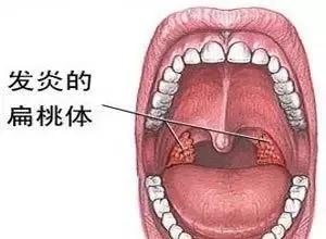 喉咙里面有白点是怎么回事