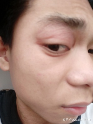 眼睛周围红是怎么回事