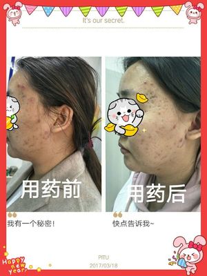 两个星期痘痘好不了