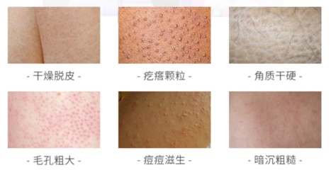 痘痘肌肤可以用精华液吗