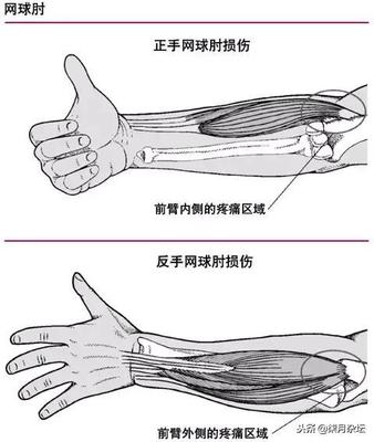手腕内侧疼是怎么回事