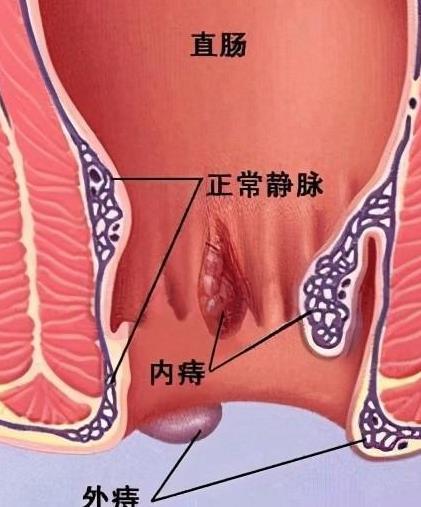 直肠疼痛是怎么回事