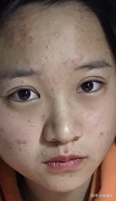 眼皮上长痘怎么办