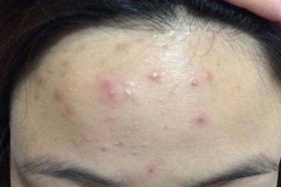 脸颊两侧长小痘痘的原因