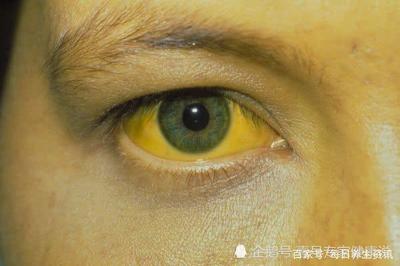 黄疸值多少眼球发黄