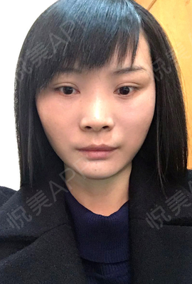 悬吊除皱v美减龄实力