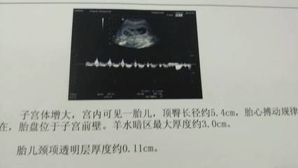 胎盘在右侧壁胎儿图片