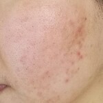 水光针治痘痘有用吗