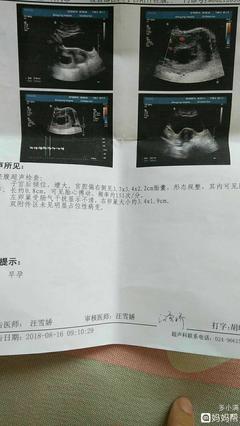 孕酮低胎儿发育正常