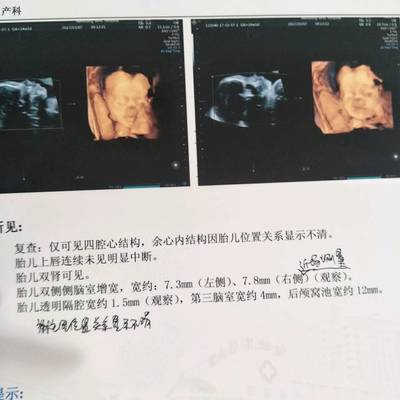怀孕初期做彩超对胎儿有影响吗