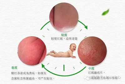 治疗宝宝红屁股的药膏