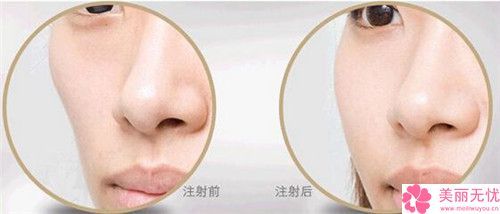 玻尿酸填充面颊