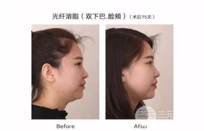 溶脂减肥的费用