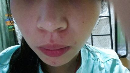 为啥老长痘痘