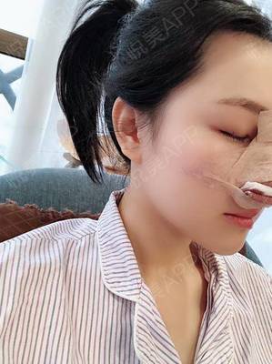 隆鼻之后多久可以吃辣