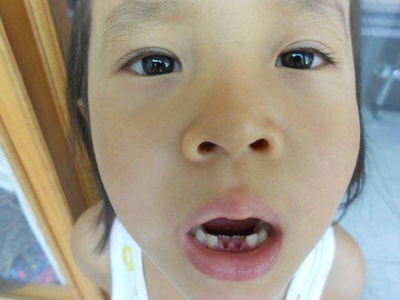 小孩怎么拔牙