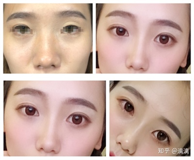隆鼻和双眼皮哪个先做