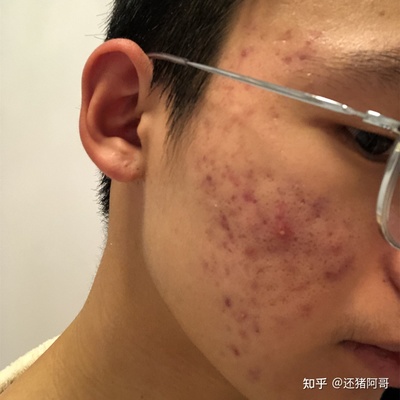 男生长痘痘要注意什么问题