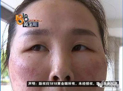脸上的痘痘几个月都不消