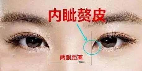 内眦赘皮双眼皮
