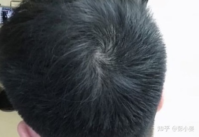 男生爱掉头发是怎么回事