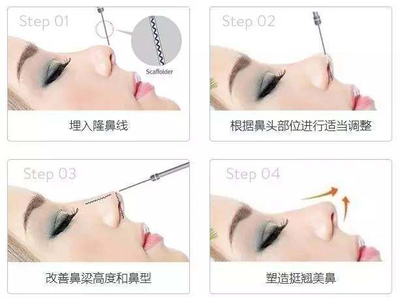 线雕隆鼻和玻尿酸区别
