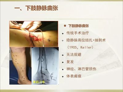 静脉曲张前期怎么治疗