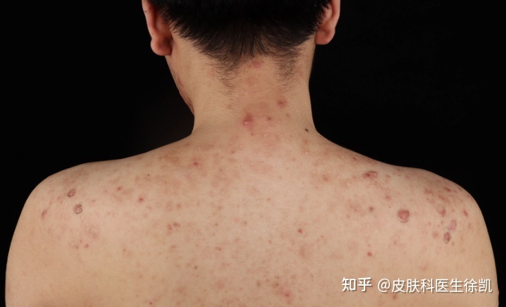 怎样消除疤痕疙瘩